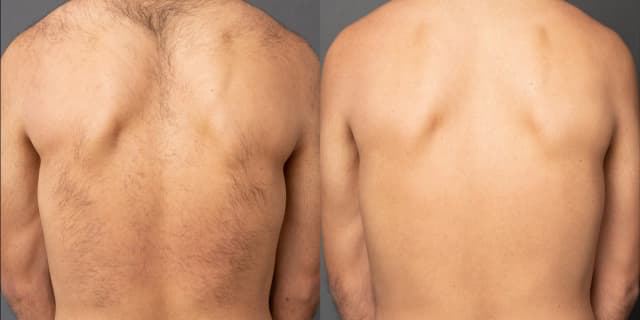 Before and after back regrowth