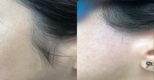Before and after hairline regrowth