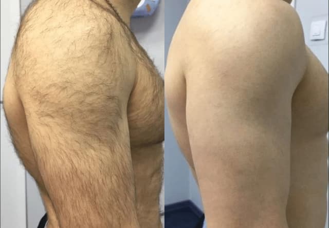 Before and after shoulder regrowth