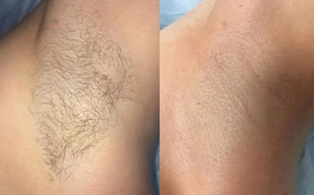 Before and after underarm regrowth