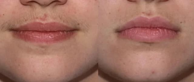 Before and after upper lip regrowth