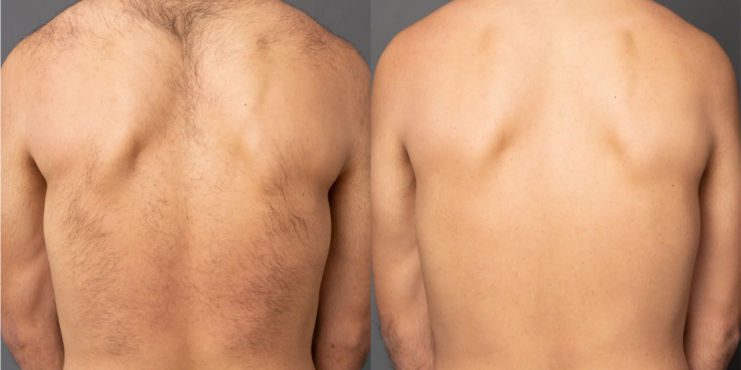 Before and after back regrowth