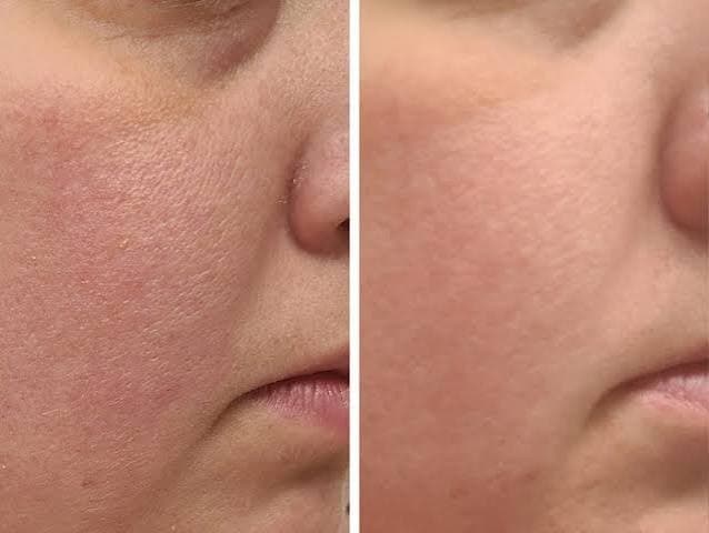 Before and after cheek regrowth
