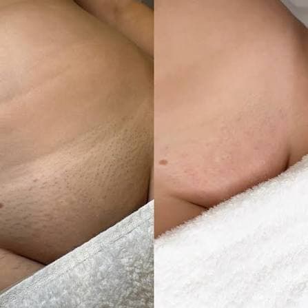 Before and after chest regrowth