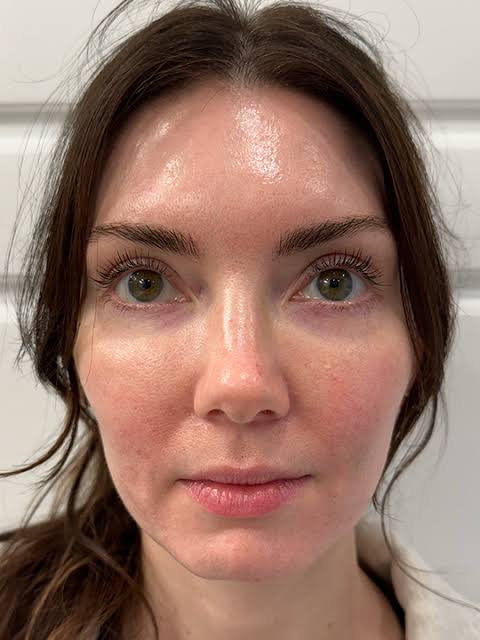 Skin results after consistent use