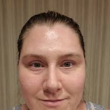 Skin results after consistent use