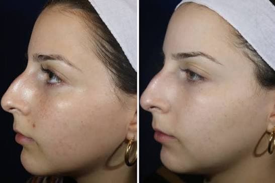 Before and after facial regrowth