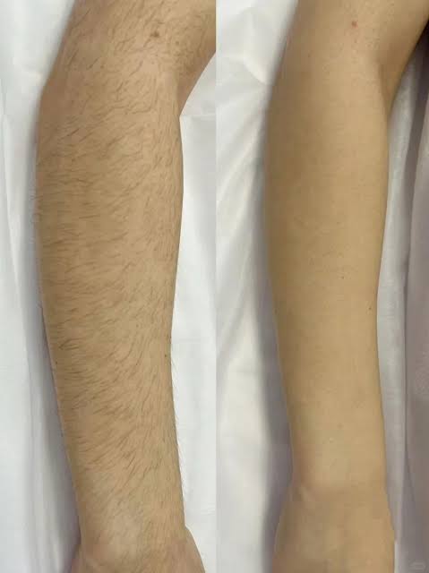 Before and after arm regrowth