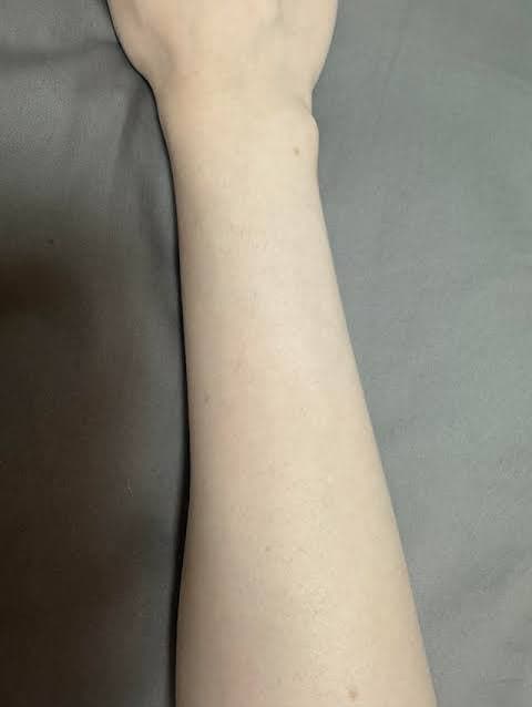Arm regrowth results after consistent use