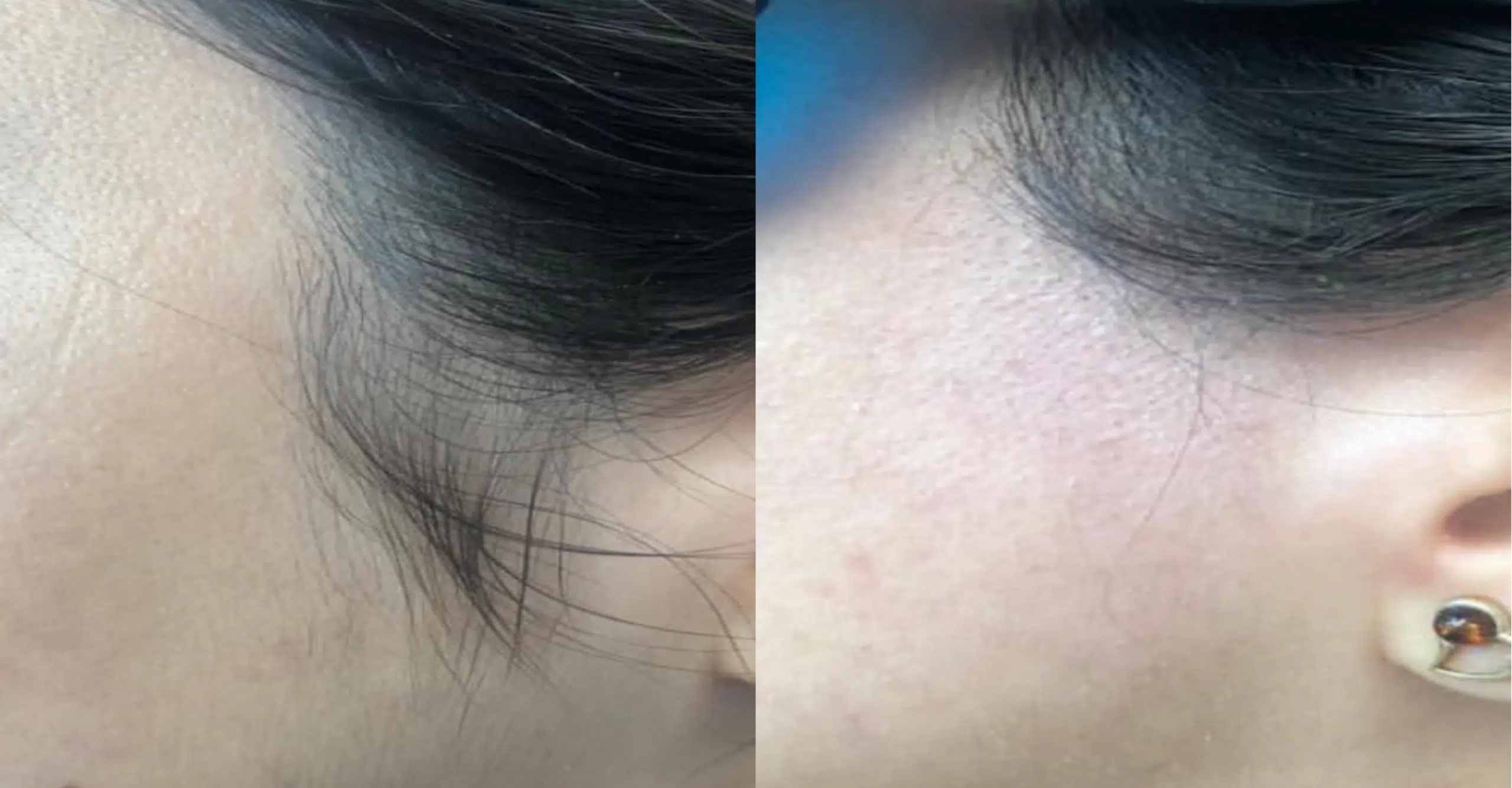 Before and after hairline regrowth