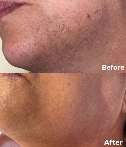 Before and after jawline regrowth