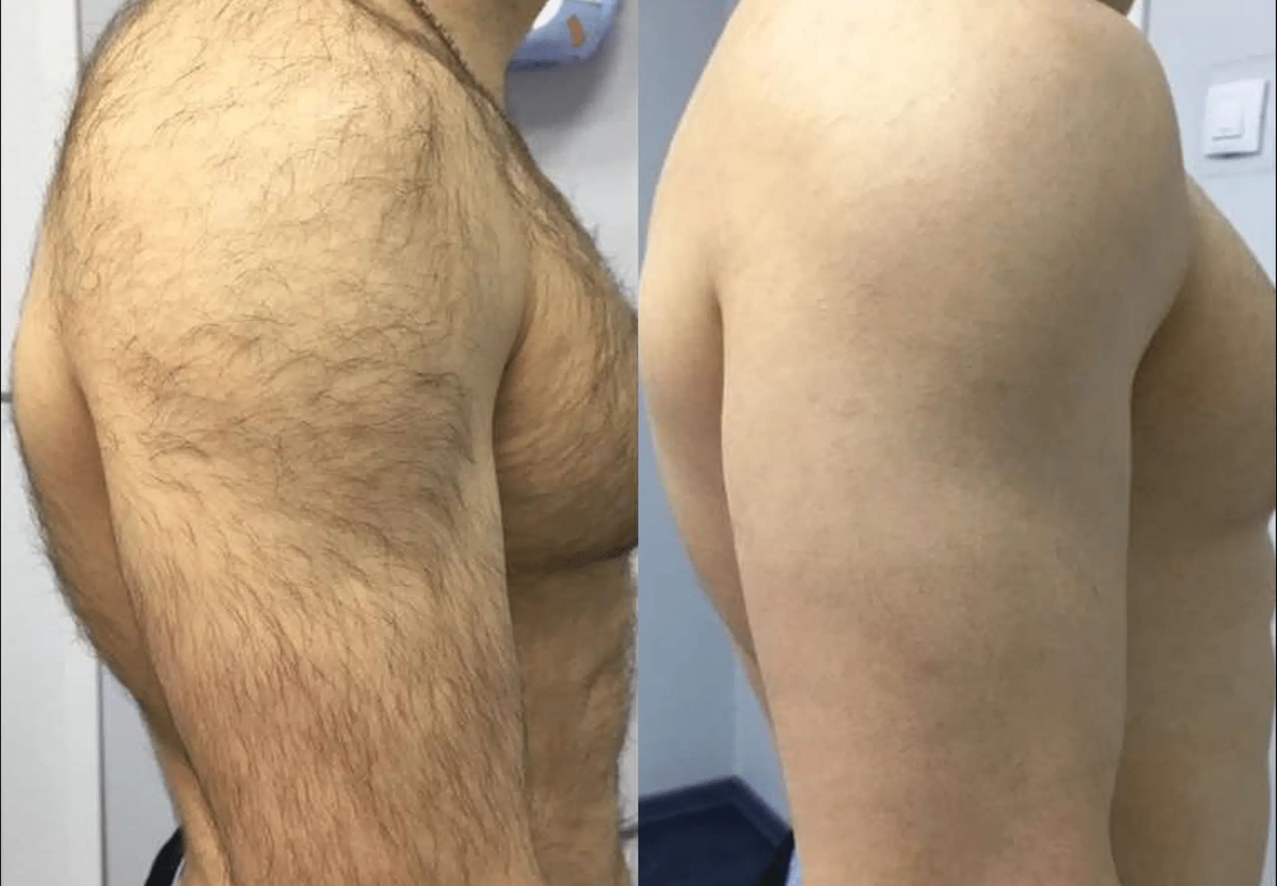 Before and after shoulder regrowth
