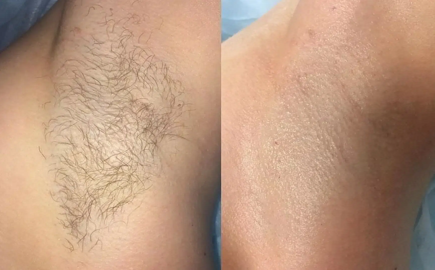 Before and after underarm regrowth