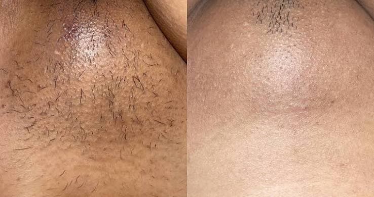 Before and after underarm regrowth