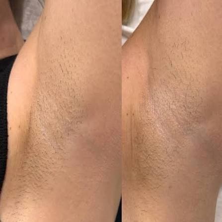 Before and after underarm regrowth