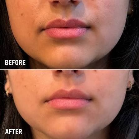 Before and after upper lip regrowth