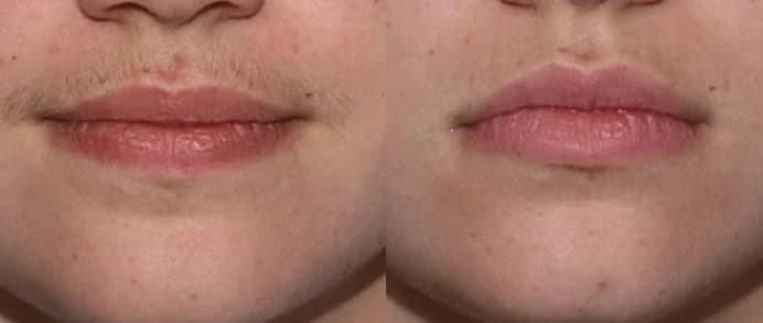 Before and after upper lip regrowth